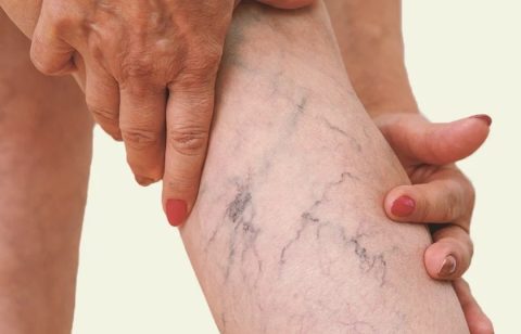 Laser-For-Beauty-15-Laser-Vascul