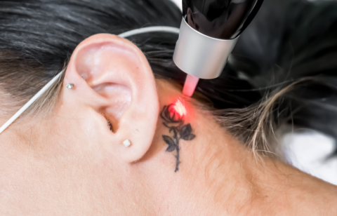Laser-Tattoo-Removal-1