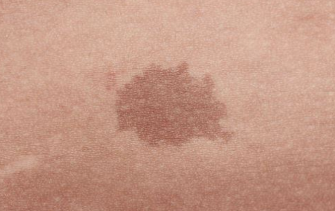 Pigmented+lesion