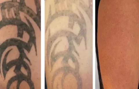 arm-tattoo-laser-removal-sq