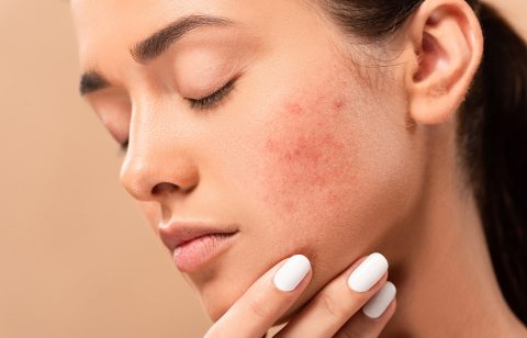 niagara-dermatology-centre-acne